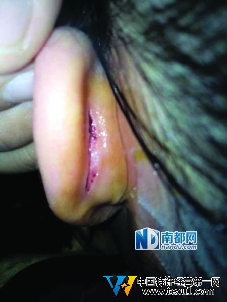 小娜受傷的耳朵。受訪者供圖