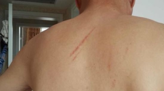 陳先生被同行毆打后,身上滿是傷痕。