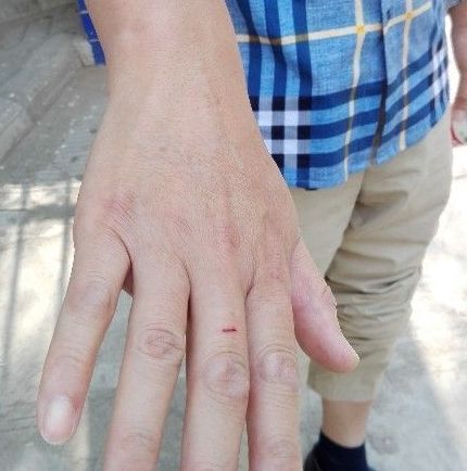 陳先生被同行毆打后,身上滿是傷痕。