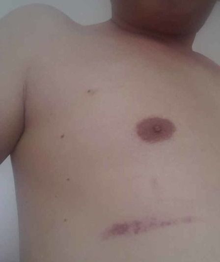 陳先生被同行毆打后,身上滿是傷痕。