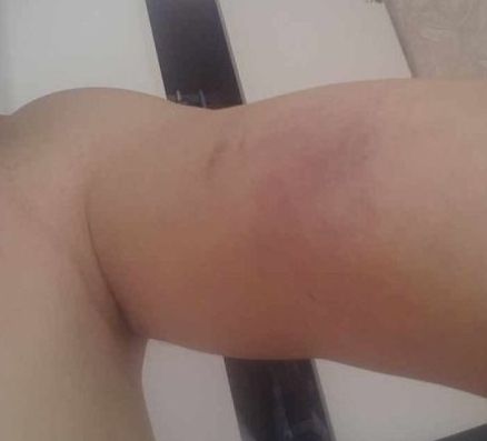 陳先生被同行毆打后,身上滿是傷痕。